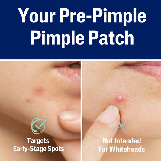 Cetaphil Gentle Clear 6 Hour Fast Clear Pimple Patches (24 Patches)